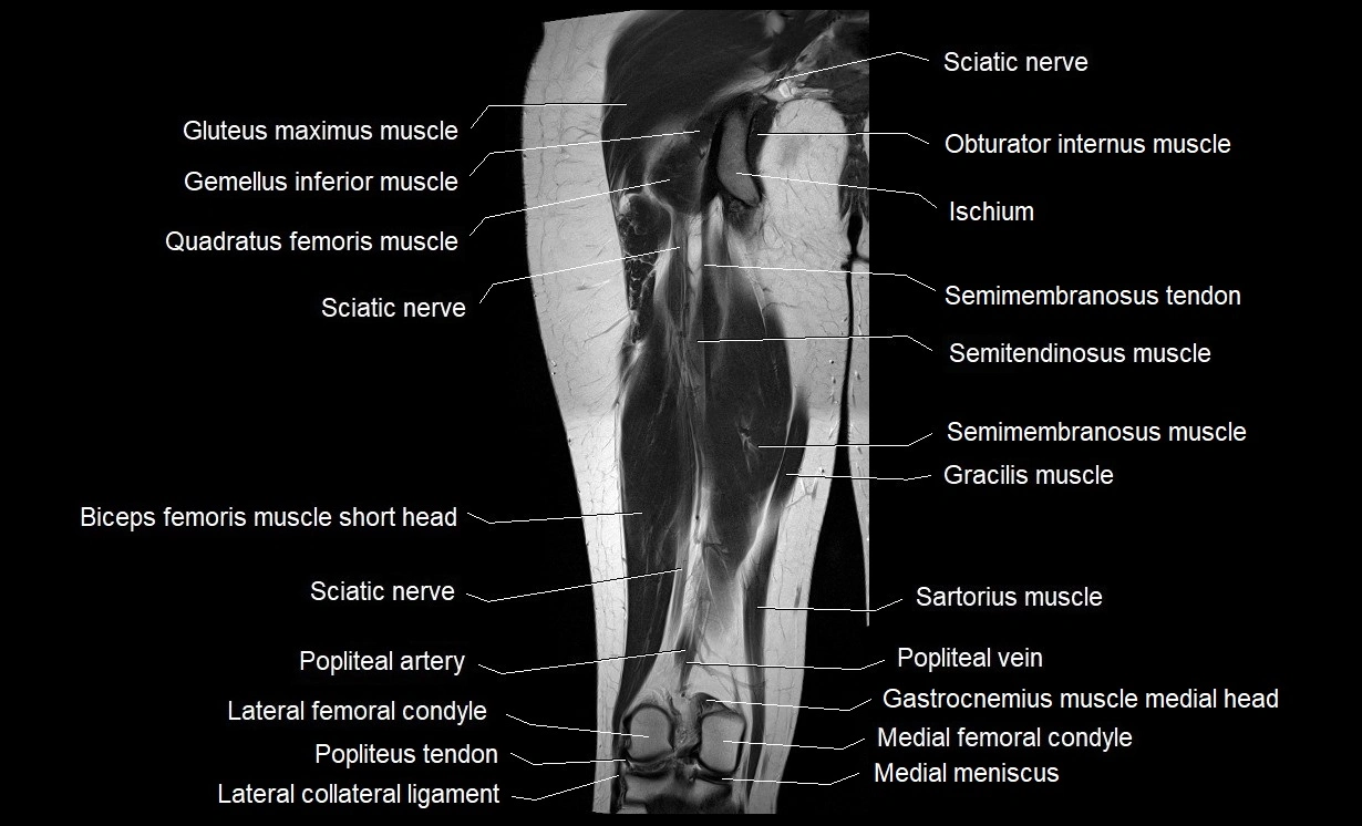 MRI thigh coronal cross sectional anatomy image 16.webp